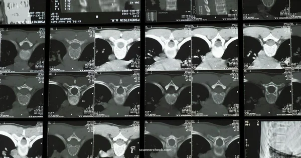 Metal Artifacts in CT - Scanner Check